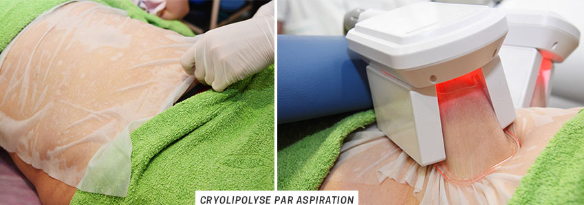 Cryolipolyse par aspiration 