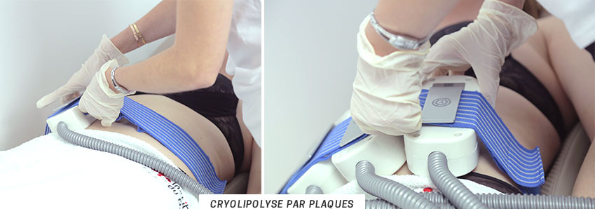 cyolipolyse par plaque